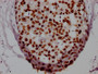 IHC image of RAC07347 diluted at 1:100 and staining in paraffin-embedded human breast cancer performed on a Leica BondTM system. After dewaxing and hydration, antigen retrieval was mediated by high pressure in a citrate buffer (pH 6.0). Section was blocked with 10% normal goat serum 30min at RT. Then primary antibody (1% BSA) was incubated at 4? overnight. The primary is detected by a Goat anti-rabbit IgG polymer labeled by HRP and visualized using 0.05% DAB. IHC image of RAC07347 diluted at 1:100 and staining in paraffin-embedded human breast cancer performed on a Leica BondTM system. After dewaxing and hydration, antigen retrieval was mediated by high pressure in a citrate buffer (pH 6.0). Section was blocked with 10% normal goat serum 30min at RT. Then primary antibody (1% BSA) was incubated at 4? overnight. The primary is detected by a Goat anti-rabbit IgG polymer labeled by HRP and visualized using 0.05% DAB.