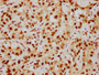 IHC image of RAC07394 diluted at 1:154 and staining in paraffin-embedded human liver cancer performed on a Leica BondTM system. After dewaxing and hydration, antigen retrieval was mediated by high pressure in a citrate buffer (pH 6.0). Section was blocked with 10% normal goat serum 30min at RT. Then primary antibody (1% BSA) was incubated at 4? overnight. The primary is detected by a biotinylated secondary antibody and visualized using an HRP conjugated SP system. IHC image of RAC07394 diluted at 1:154 and staining in paraffin-embedded human liver cancer performed on a Leica BondTM system. After dewaxing and hydration, antigen retrieval was mediated by high pressure in a citrate buffer (pH 6.0). Section was blocked with 10% normal goat serum 30min at RT. Then primary antibody (1% BSA) was incubated at 4? overnight. The primary is detected by a biotinylated secondary antibody and visualized using an HRP conjugated SP system.