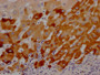 IHC image of RAC07489 diluted at 1:100 and staining in paraffin-embedded human liver cancer performed on a Leica BondTM system. After dewaxing and hydration, antigen retrieval was mediated by high pressure in a citrate buffer (pH 6.0). Section was blocked with 10% normal goat serum 30min at RT. Then primary antibody (1% BSA) was incubated at 4? overnight. The primary is detected by a Goat anti-rabbit IgG polymer labeled by HRP and visualized using 0.05% DAB. IHC image of RAC07489 diluted at 1:100 and staining in paraffin-embedded human liver cancer performed on a Leica BondTM system. After dewaxing and hydration, antigen retrieval was mediated by high pressure in a citrate buffer (pH 6.0). Section was blocked with 10% normal goat serum 30min at RT. Then primary antibody (1% BSA) was incubated at 4? overnight. The primary is detected by a Goat anti-rabbit IgG polymer labeled by HRP and visualized using 0.05% DAB.