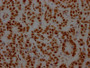 IHC image of RAC07547 diluted at 1:100 and staining in paraffin-embedded human breast cancer performed on a Leica BondTM system. After dewaxing and hydration, antigen retrieval was mediated by high pressure in a citrate buffer (pH 6.0). Section was blocked with 10% normal goat serum 30min at RT. Then primary antibody (1% BSA) was incubated at 4? overnight. The primary is detected by a Goat anti-rabbit IgG polymer labeled by HRP and visualized using 0.05% DAB.