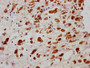 IHC image of RAC07623 diluted at 1:100 and staining in paraffin-embedded human melanoma cancer performed on a Leica BondTM system. After dewaxing and hydration, antigen retrieval was mediated by high pressure in a citrate buffer (pH 6.0). Section was blocked with 10% normal goat serum 30min at RT. Then primary antibody (1% BSA) was incubated at 4? overnight. The primary is detected by a biotinylated secondary antibody and visualized using an HRP conjugated SP system.