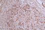 IHC image of RAC07946 diluted at 1:300 and staining in paraffin-embedded human pancreatic cancer performed on a Leica BondTM system. After dewaxing and hydration, antigen retrieval was mediated by high pressure in a citrate buffer (pH 6.0). Section was blocked with 10% normal goat serum 30min at RT. Then primary antibody (1% BSA) was incubated at 4°C overnight. The primary is detected by a Goat anti-Mouse IgG labeled by HRP and visualized using 0.05% DAB.