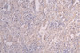 IHC image of RAC07986 diluted at 1:300 and staining in paraffin-embedded human lung cancer performed on a Leica BondTM system. After dewaxing and hydration, antigen retrieval was mediated by high pressure in a citrate buffer (pH 6.0). Section was blocked with 10% normal goat serum 30min at RT. Then primary antibody (1% BSA) was incubated at 4°C overnight. The primary is detected by a Goat anti-Human IgG labeled by HRP and visualized using 0.05% DAB.
