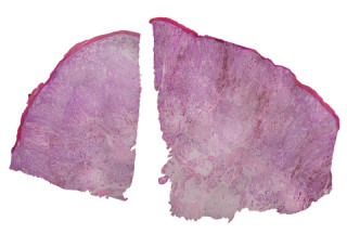Prepared Microscope Slide, Melanoma (Human); Cross Section; H&E Stain