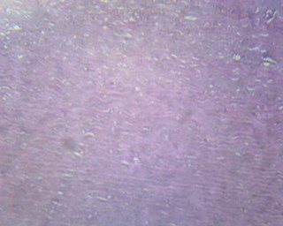 Prepared Microscope Slide, Atherosclerosis (Human); Section; H&E Stain; Showing Section of Coronary Artery