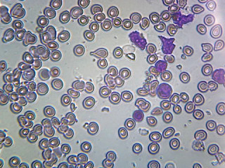 Prepared Microscope Slide, Acute Lymphatic Leukemia; Smear (From Blood); GS Stain; Showing Abnormal Lymphocytes