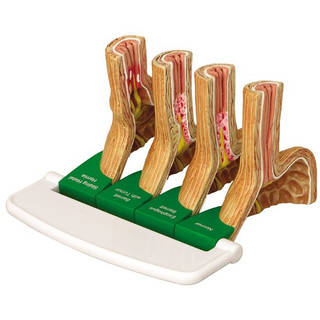 Four-Stage GERD Progression Anatomical Model_main
