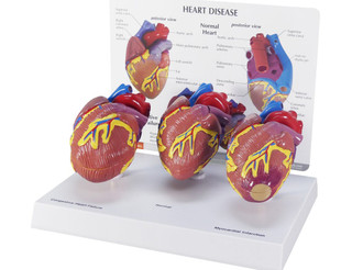 Normal Heart Anatomy; Myocardial Infarction Heart and Congestive Heart Failure Models_main