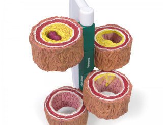Four-Stage Cross-Section Artery Atherosclerosis Model_main