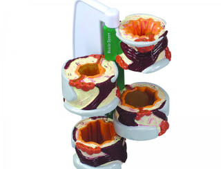 Four-Stage Bronchus Model for Asthma & Bronchitis_main