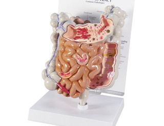 Cut-Away Intestine Model with Pathologies_main