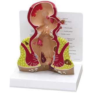 Rectum Anatomy Model with Common Pathologies_main