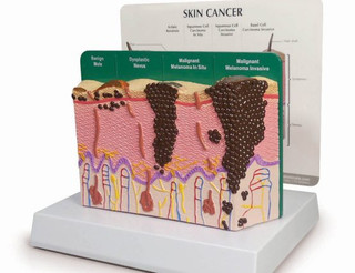 Enlarged Skin Cross-Section Lesion Model_main