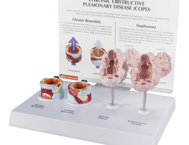 Enlarged COPD Bronchus and Alveoli Model