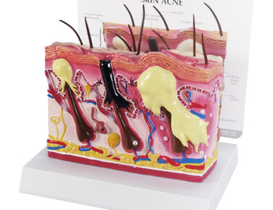 Exaggerated Skin Enlarged Skin Model Showing Three Acne Conditions