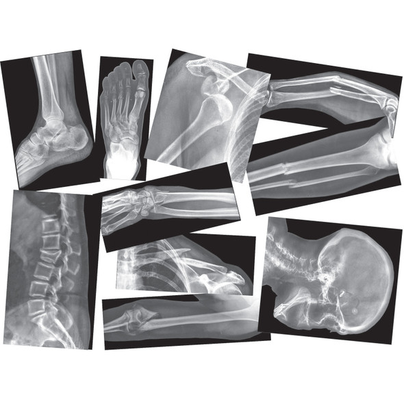 Broken Bones X-Ray Set, Pack of 15
