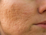 HOW DO I GET RID OF ACNE SCARS? 