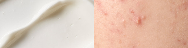SUMMER ACNE 101