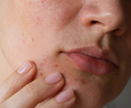 WHAT IS PERIORAL DERMATITIS?