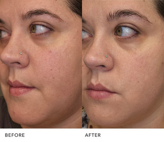  Before and after skin improvement with PITERA™ essence: Improved Skin Texture | SK-II USA
