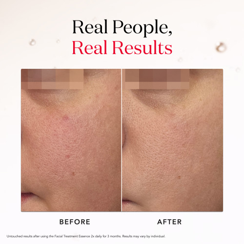 SK-II Facial Treatment Essence: Real people results