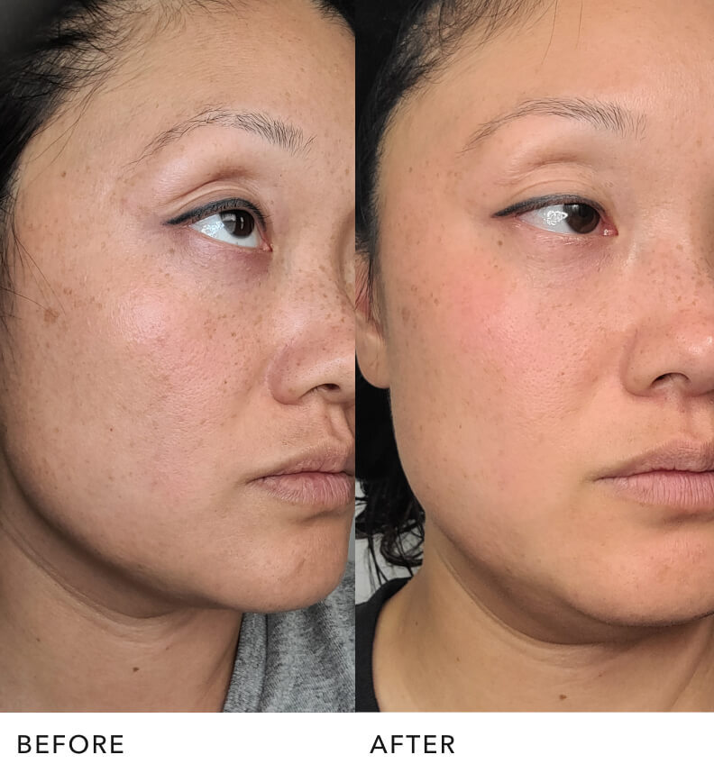 PITERA before and after carousel image