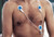Ambu® BlueSensor SP