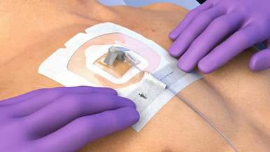 3M™ Tegaderm™ CHG I.V. Port Dressing Kits Transparent (12 x 12 cm ...