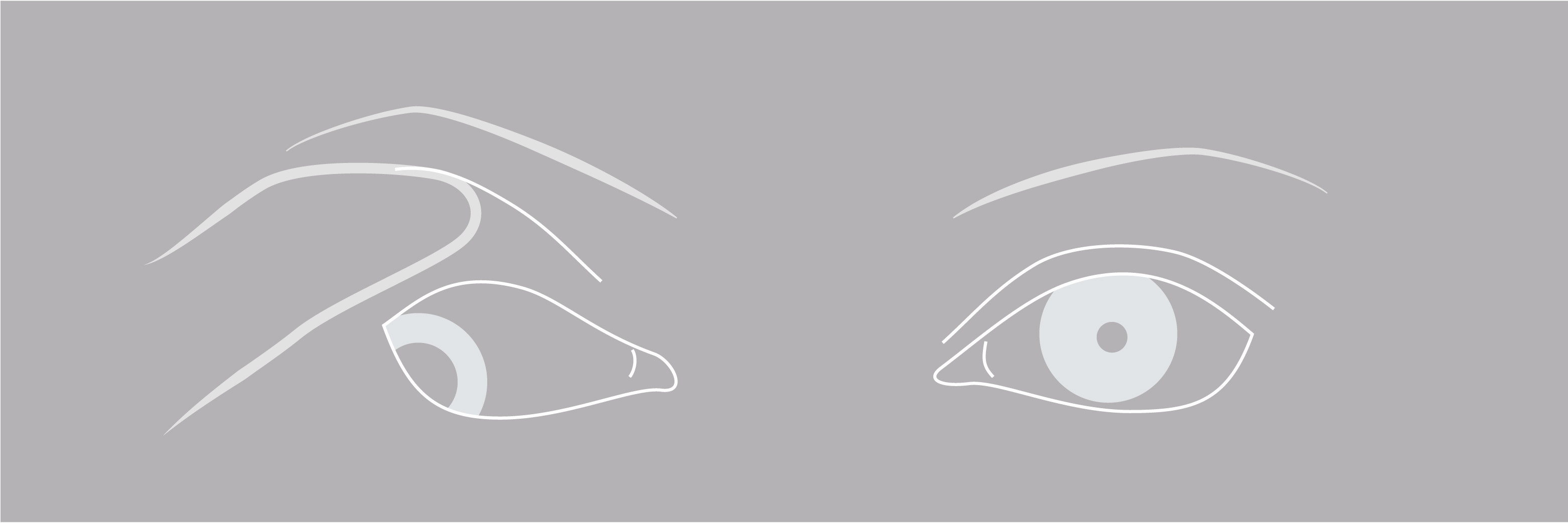 Pupil-Involved vs. Pupil-Sparing Acquired Oculomotor Nerve Palsy
