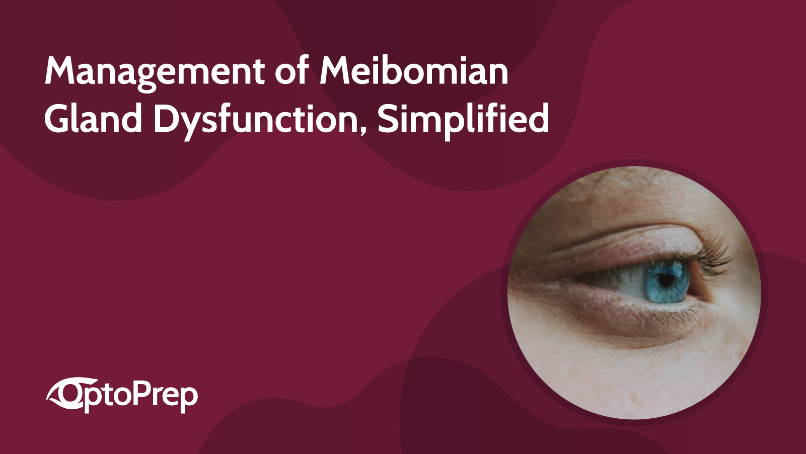 Management of Meibomian Gland Dysfunction, Simplified 