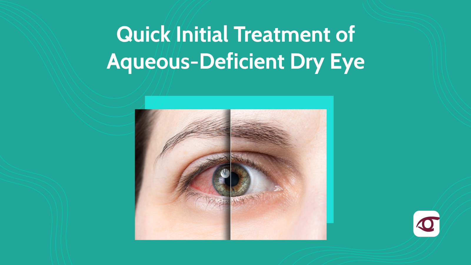 Quick Initial Treatment of Aqueous-Deficient Dry Eye