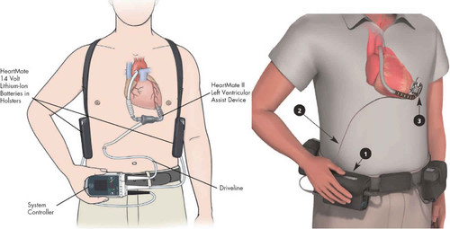 Medline DM330A - UOU LVAD Driveline Management, Complications