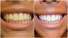 Flawless Teeth Whitening Pen
