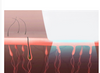 IPL Laser Hair Removal