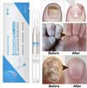 FUNGAL NAIL REPAIR PEN