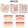 Invisible Oil Control Isolation Acne Concealer Acne Pimple Sticker