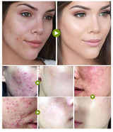 Ultra-Clarifying Acne Out Serum