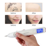 Laser Freckle Removal Machine - Skin Mole Removal