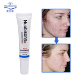 Nuobisong face skin care treatment the face Pimples scar Stretch Marks removal acne treatment whitening moisturizing cream