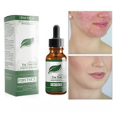 100% Tea Tree Pure Essential Oil Face Care Skin Acne Treatment Oil Blackhead Remover Anti Scar Spots Facial