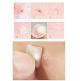 Skin Tag Remover Patch