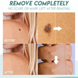 Skin Tag Remover Patch