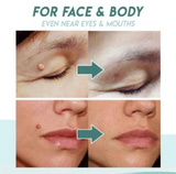 Skin Tag Remover Patch