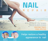 Fungal Nail Treatment Pen Anti Infection Gel Foot Toe Nail