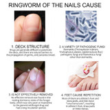 Nail Fungus Treatment Pen