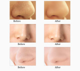 Electric Acne Pore Cleaner Blackhead Vacuum