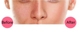 Electric Acne Pore Cleaner Blackhead Vacuum