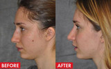 Skin Tag & Acne Patch