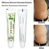 10pcs Dermatitis Eczema Skin Care Cream