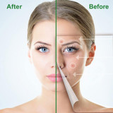 Effective Pimple Master Patch Facial Invisible Sticker Treatment Beauty Mask
